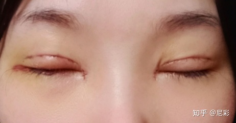 双眼皮闭眼照