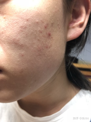 两个星期痘痘好不了