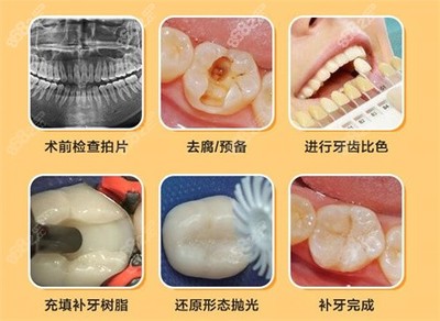 补牙价格
