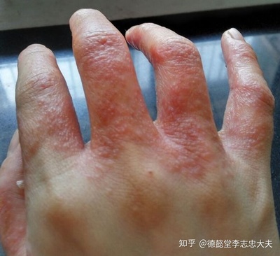 汗疱疹怎么治疗