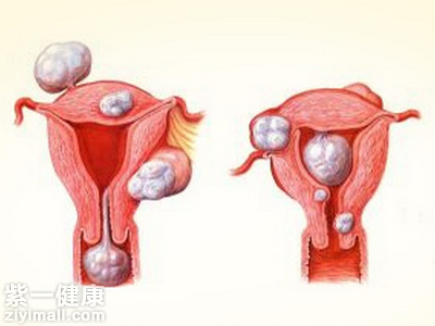 宫颈炎影响怀孕吗