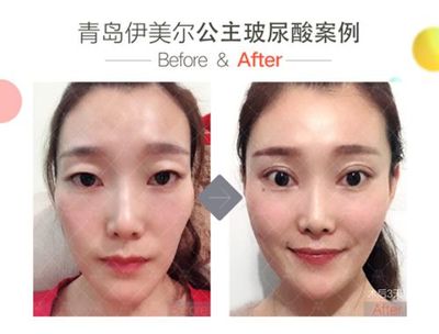 玻尿酸填充多久恢复自然
