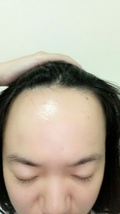 脸上有痘痘适合什么发型