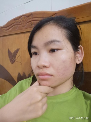 根除痘痘 痘印