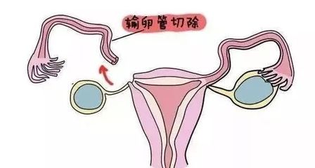 单侧输卵管怀孕的技巧