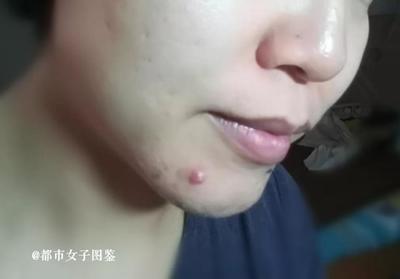 痘痘流脓可以贴痘痘贴吗