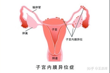 输卵管通而不畅会怀孕吗
