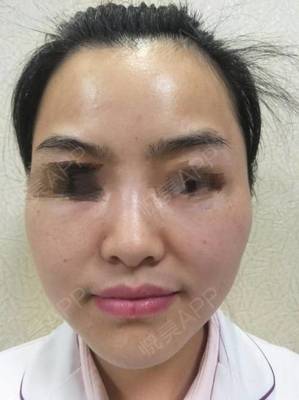 额头痘痘肿了怎么办啊