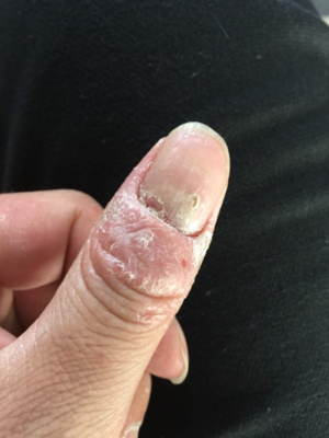 手指甲蜕皮是怎么回事
