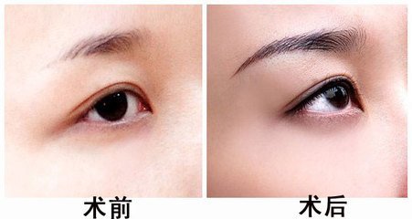 纹眉后忌口