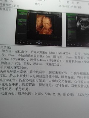 胎儿双顶径标准看男女