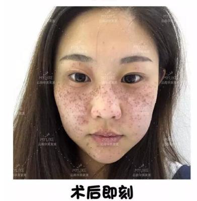 激光祛斑 术后