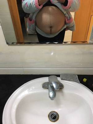 没怀孕会有妊娠线吗