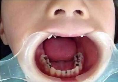 做梦梦到牙齿烂了