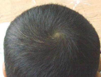 宝宝头顶旋偏右说法