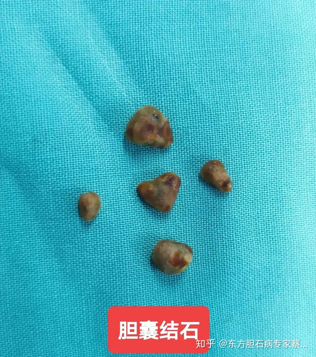 结石怎么治疗效果好