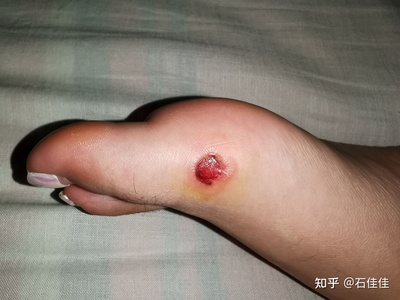 伤口发黑是怎么回事
