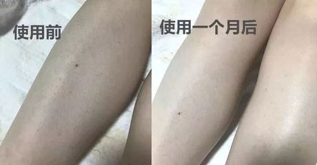 消除背部痘印