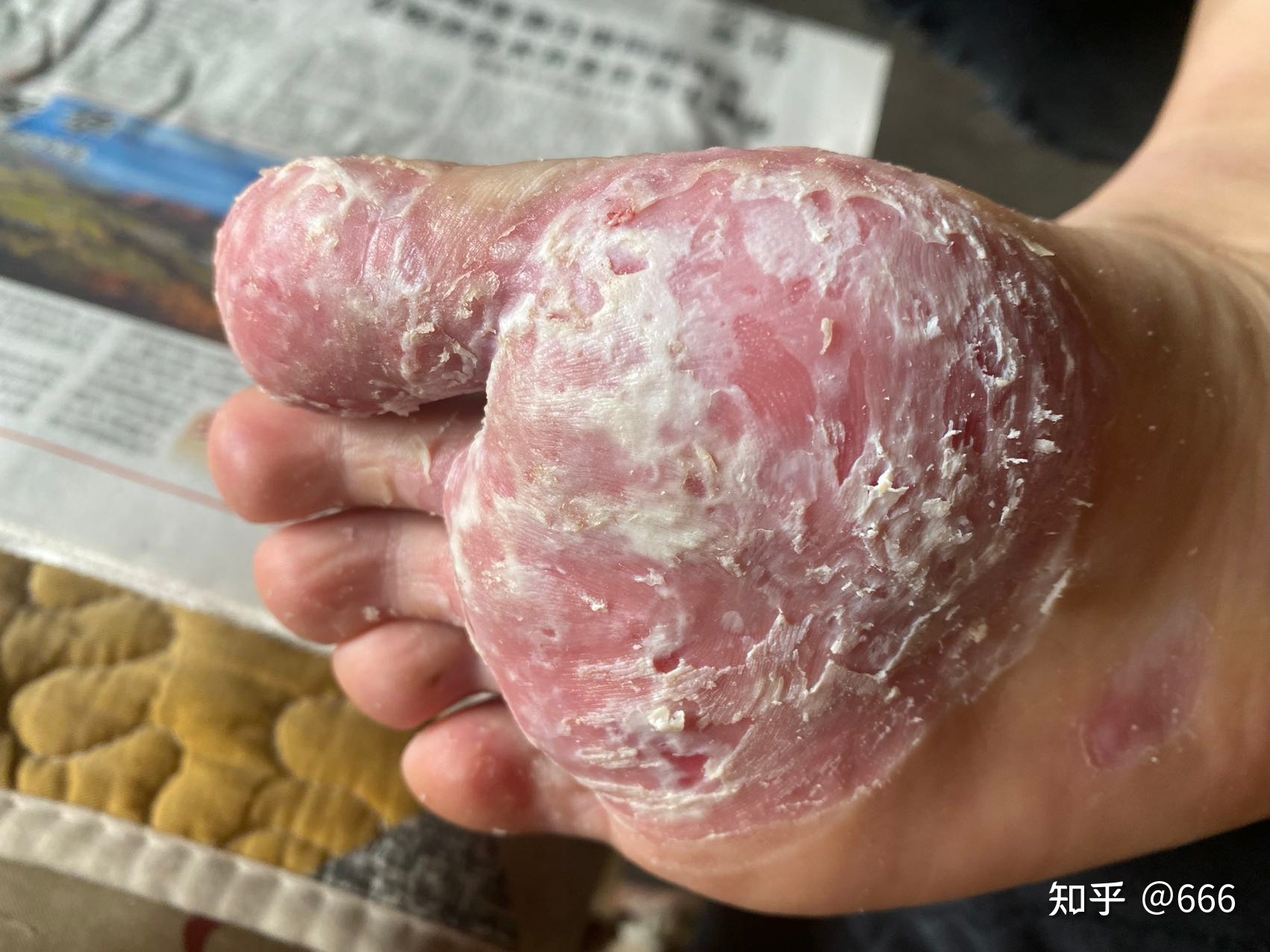 身上长肉刺是怎么回事