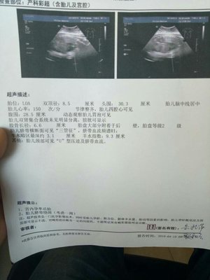 34周胎儿股骨长标准值