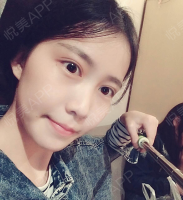 做完双眼皮冰敷多久