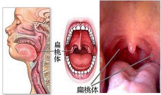 扁桃体发炎微创需要多少钱