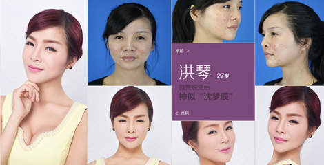 漂亮的脸被痘痘毁了