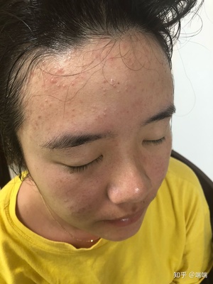 30多岁 右脸长痘痘