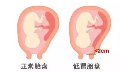 孕妇胎盘低怎么办