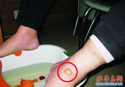 泡脚脚起泡是怎么回事