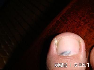 指甲上有黑纹是怎么回事