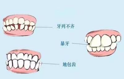 牙齿矫正好处