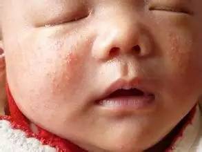 新生儿起了湿疹怎么办