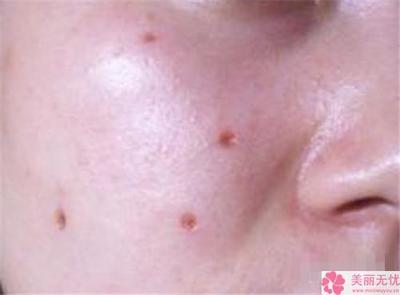激光治疗痘痘需要注意什么