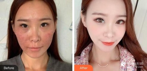 激光祛斑后可以化妆吗