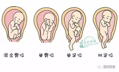 胎儿一直臀位说明宝宝有问题