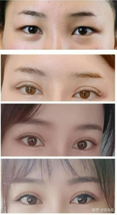 单眼皮怎么整双眼皮
