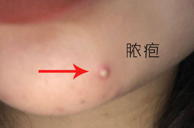 痘痘会不会越挤越多