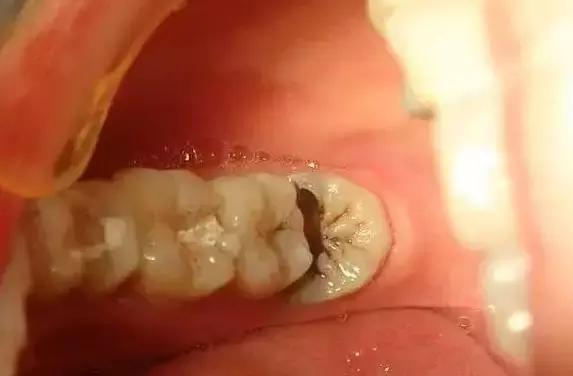 拔牙后感染了怎么办