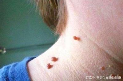 头颈长痘痘是什么原因