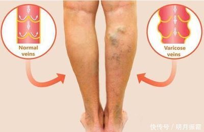 下肢血管堵塞怎么治疗
