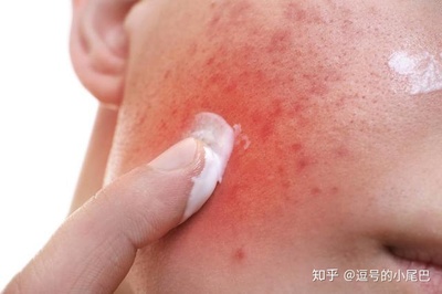 刚冒的痘痘怎么处理