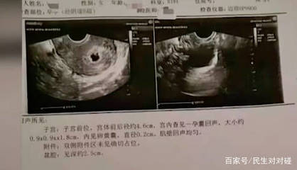 结扎三年了还会怀孕吗