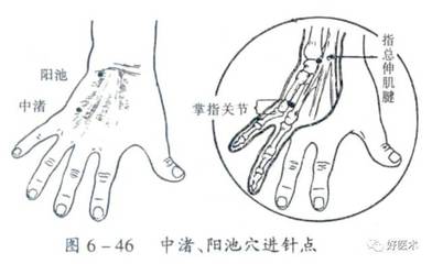 腱鞘积液是怎么回事