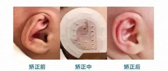 新生儿外耳畸形