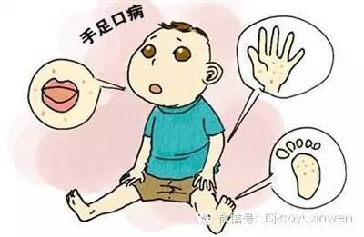儿童手足口病怎么治疗