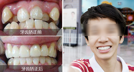 牙齿微龅如何矫正