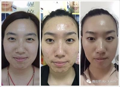 脸上雀斑痘痘怎么护肤