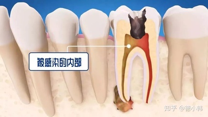 牙疼根管治疗是怎么治疗的