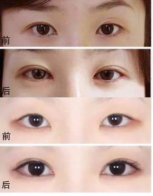 单眼皮如何画出双眼皮